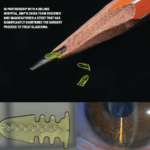 Fortune Glaucoma Stent